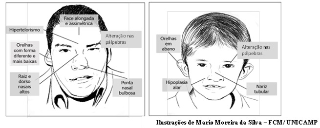 Figura 2 (Ilustrações de Mario Moreira da Silva – FCM/ UNICAMP):
Ilustração baseada em fotos de pessoas com a Síndrome de deleção 22q11.2.