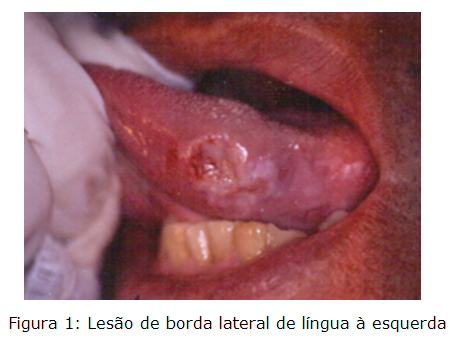 Lesão de borda lateral de língua à esquerda