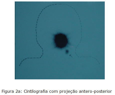 Cintolografia com projeção antero-posterior