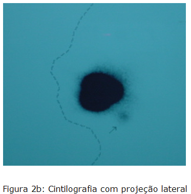 Cintilografia com projeção lateral