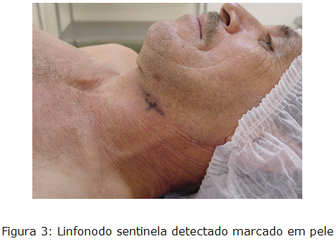 Linfonodo sentinela detectado marcado em pele