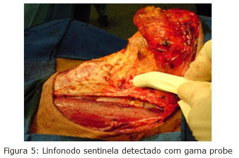 Linfonodo sentinela detectado com gama probe