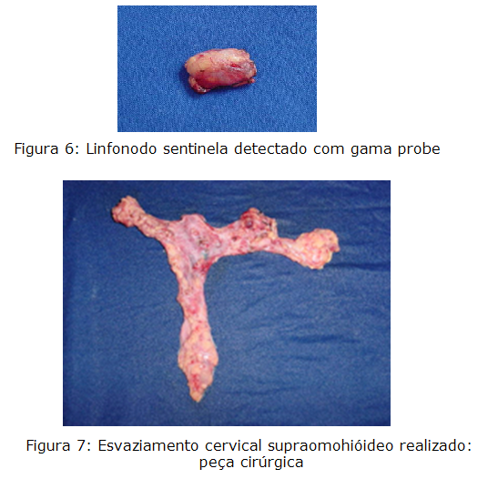Linfonodo sentinela detectado com gama probe / Esvaziamento cervical supraomohióideo realizado: peça cirúrgica