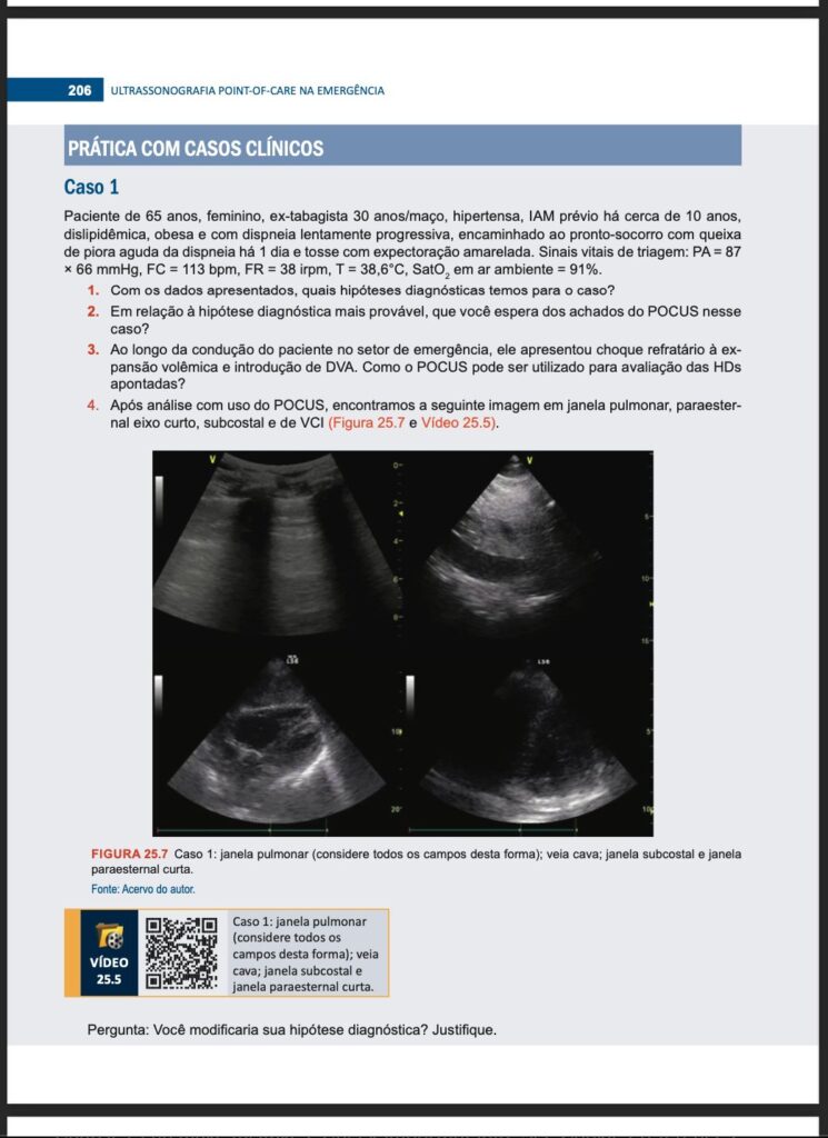 Página de livro com o título “PRÁTICA COM CASOS CLÍNICOS – Caso 1”. Descreve o caso de uma paciente de 65 anos com múltiplas comorbidades e sintomas respiratórios. O texto apresenta questões para discussão diagnóstica baseadas no uso de ultrassonografia point-of-care (POCUS). Abaixo do texto, há quatro imagens em preto e branco de exames de ultrassom, mostrando janela pulmonar, veia cava inferior (VCI), janela subcostal e paraesternal curta. Um QR code à esquerda direciona para vídeo complementar (Vídeo 25.5).