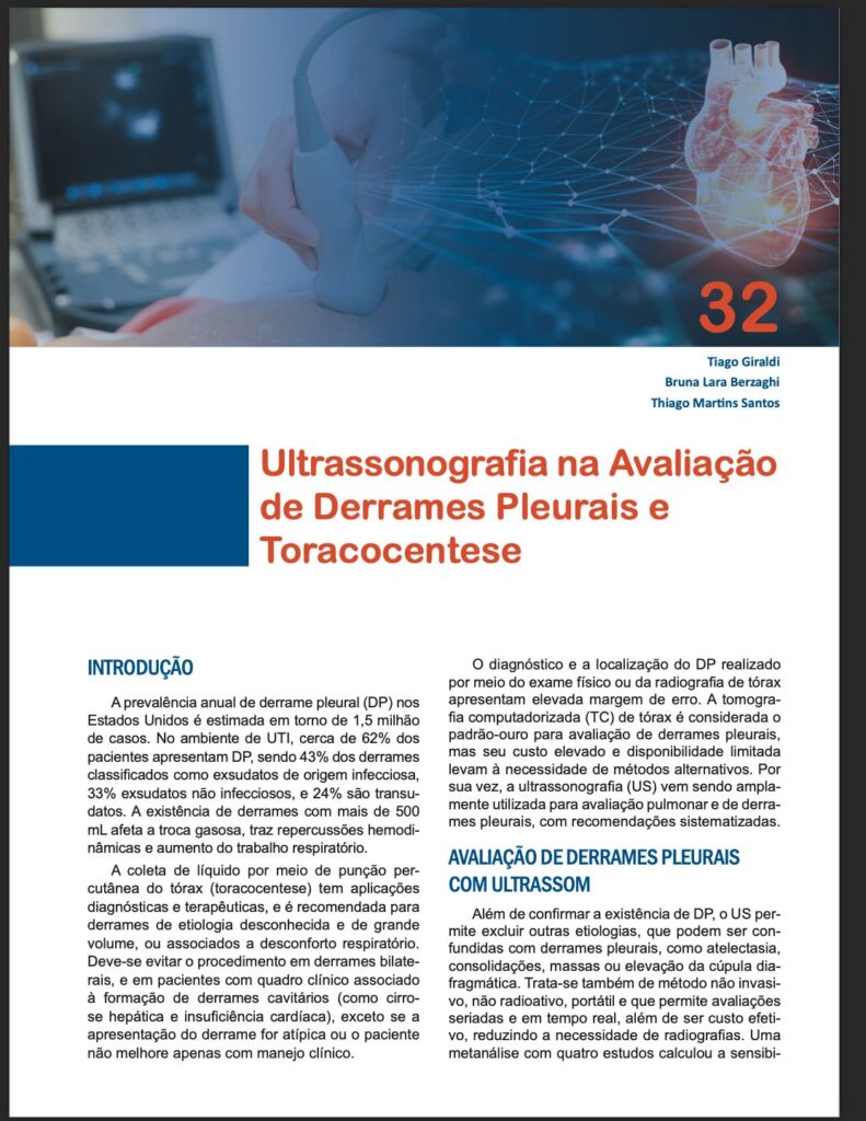 Capa do capítulo 32 do livro “POCUS: Point of Care Ultrasound em Medicina de Emergência”. O título do capítulo, em destaque, é “Ultrassonografia na Avaliação de Derrames Pleurais e Toracocentese”, de autoria de Tiago Giraldi, Bruna Lara Berzaghi e Thiago Martins Santos. A imagem de fundo mostra uma mão segurando um transdutor de ultrassom em exame torácico e uma ilustração digital de um coração em destaque. Abaixo, parágrafos de introdução explicam a prevalência de derrames pleurais, indicações de toracocentese e benefícios da ultrassonografia (POCUS) na prática médica.